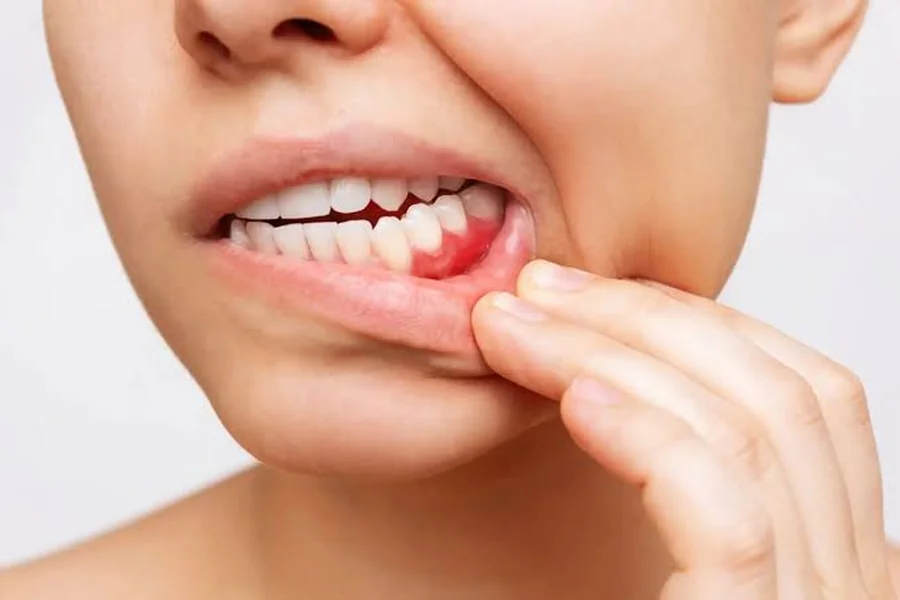 Why Gums Pull Back, Explained by a Dentist in Lubbock, TX, at Allington Dental & Braces Gums